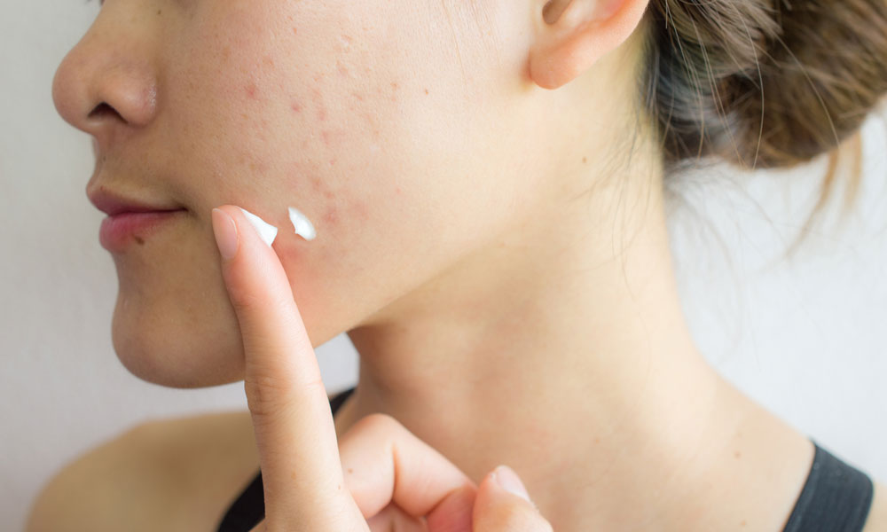 Organic Skincare for Adult Acne A Calm, Consistent Approach Blog Image